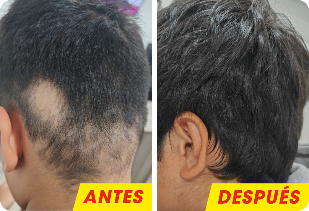 ALOPECIA