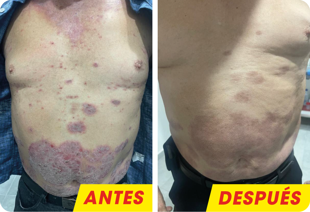PSORIASIS