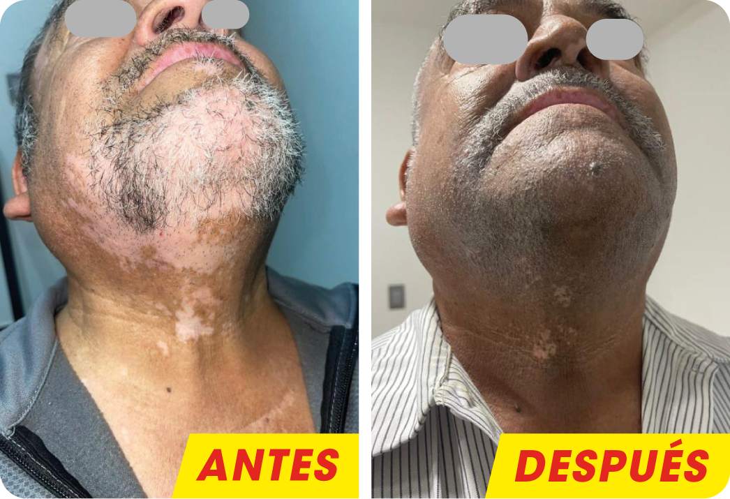 VITILIGO