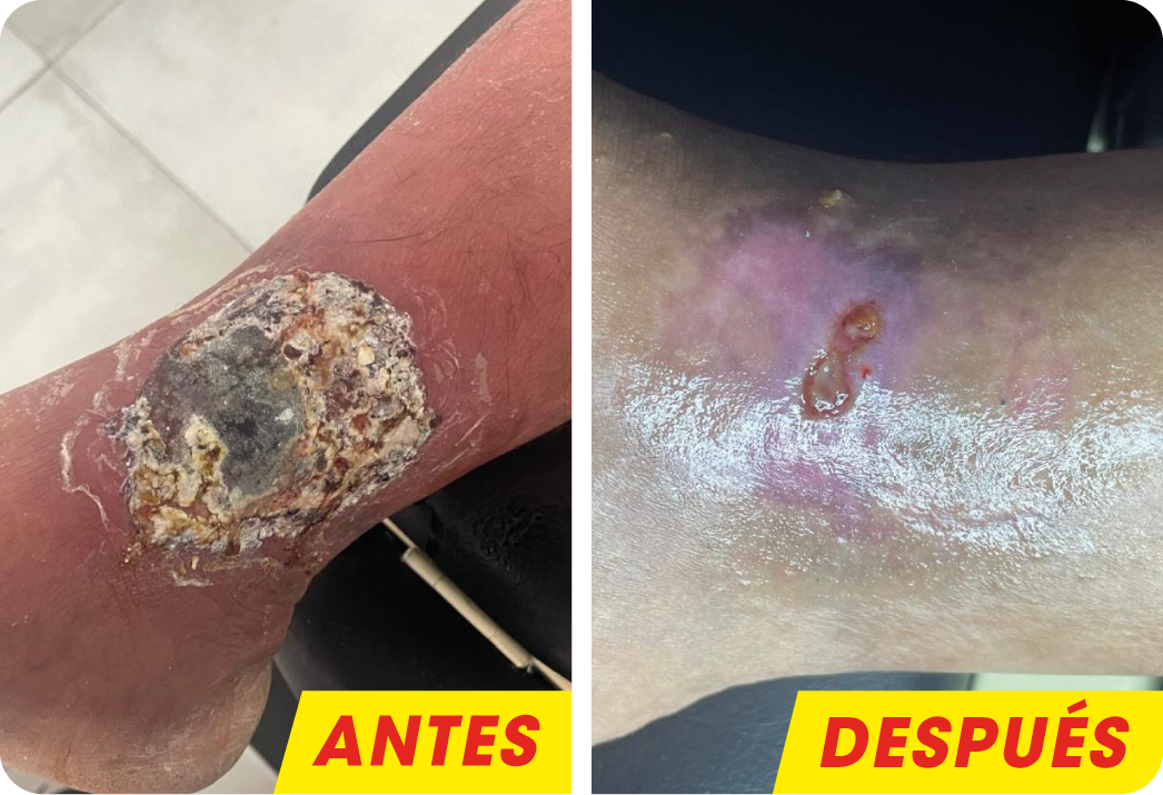 ÚLCERA VENOSA